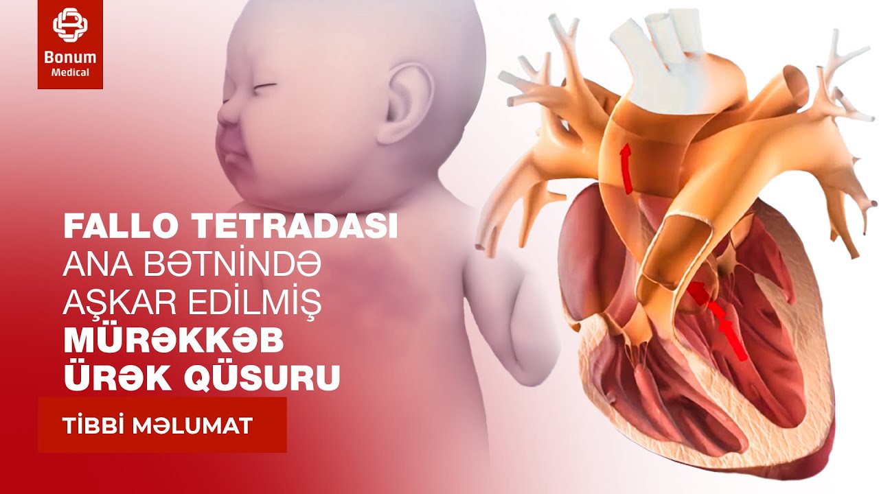 ANA BƏTNİNDƏ AŞKAR EDİLMİŞ MÜRƏKKƏB ÜRƏK QÜSURU - FALLO TETRADASI