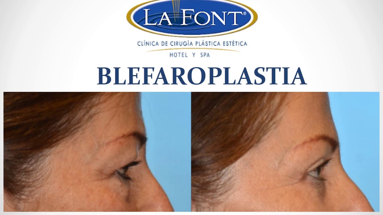 FRONTOPLASTIA Y BLEFAROPLASTIA DR. FERNANDO PEDROZA