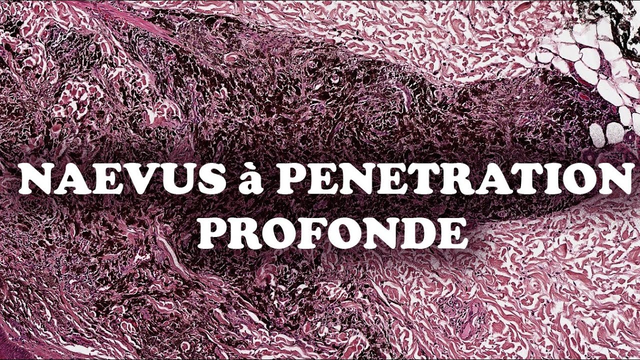 LE NAEVUS A PENETRATION PROFONDE - PATHOLOGIE