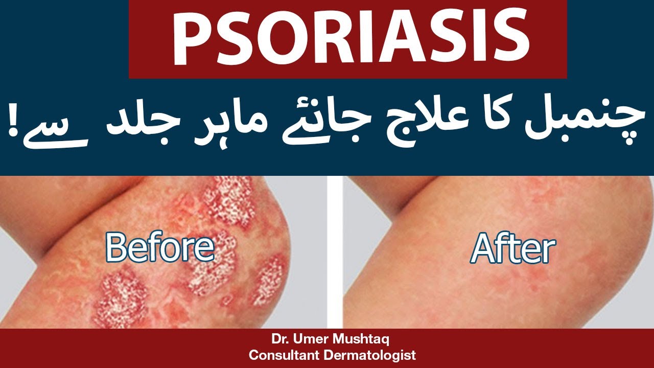 Psoriasis Treatment In Urdu (Chambal Ka Ilaj) | By Dr. Umer Mushtaq - Best Skin Specialist