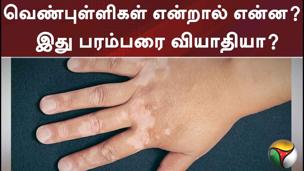 வெண்புள்ளிகள் என்றால் என்ன?  இது பரம்பரை வியாதியா?