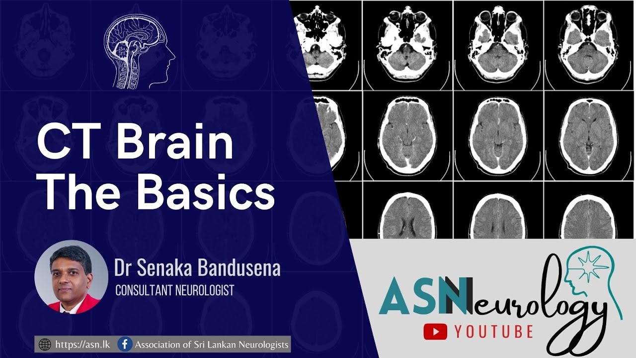 Neurology Basics - CT Brain by Dr Senaka Bandusena