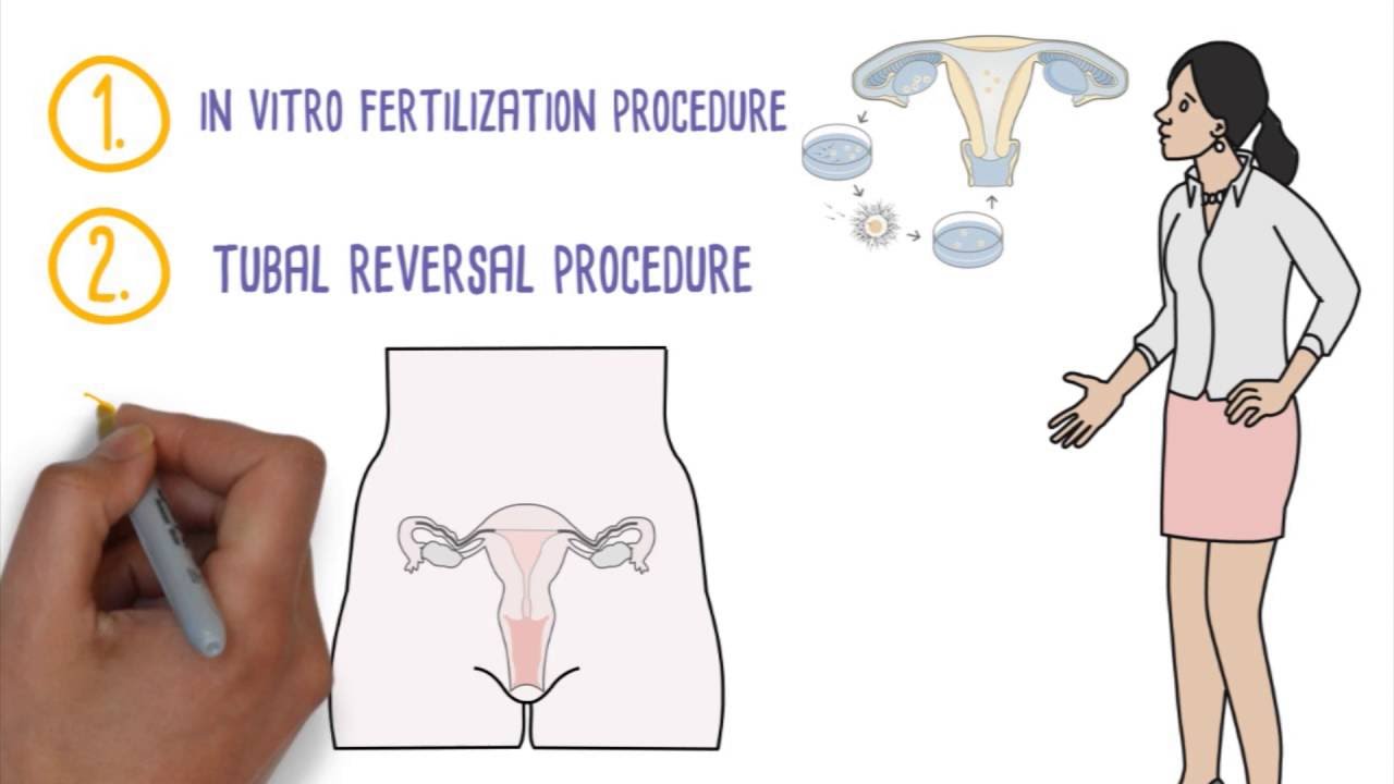 Basics of Tubal Ligation Reversal from Rocky Mountain Fertility Center