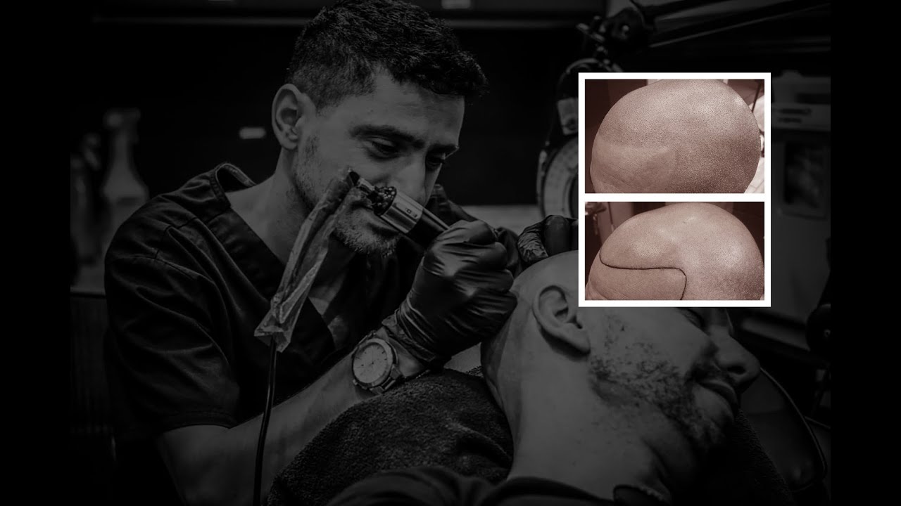 Micro Scalp Pigmentation demonstration video | Los Angeles Scalp Micropigmentation