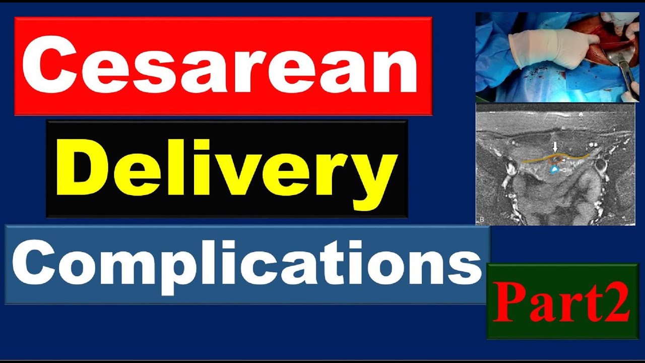 Cesarean Delivery Complications( Part2), Gynecologic Imaging