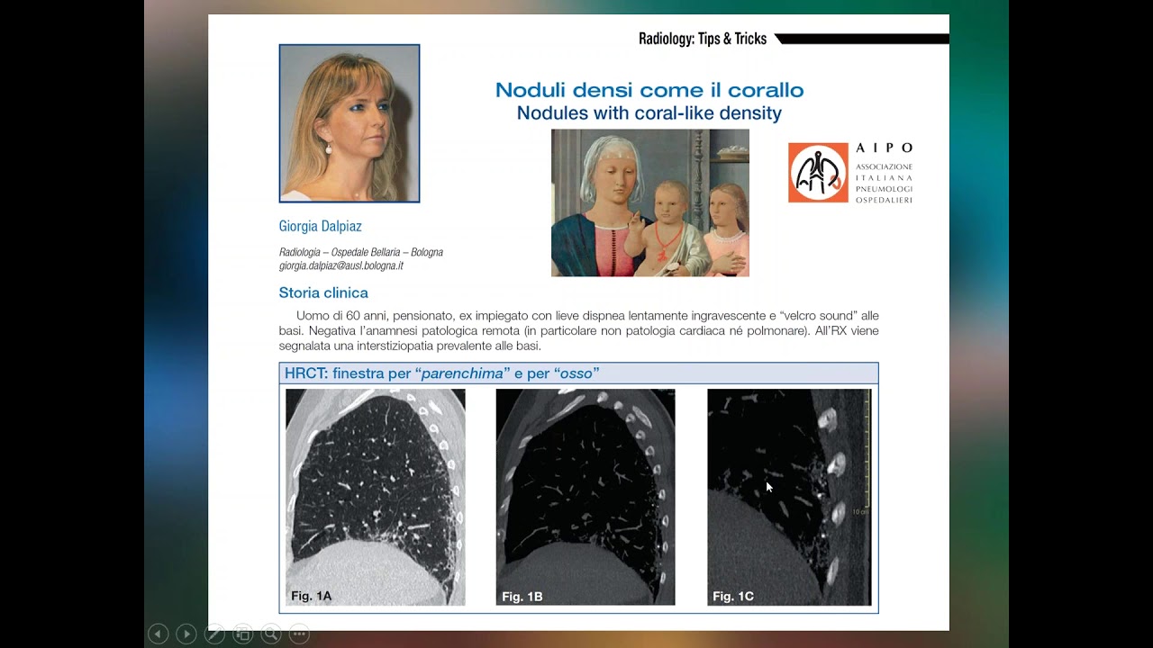Imaging HRCT dell’IPF  confini solidi liquidi e nuove linee guida