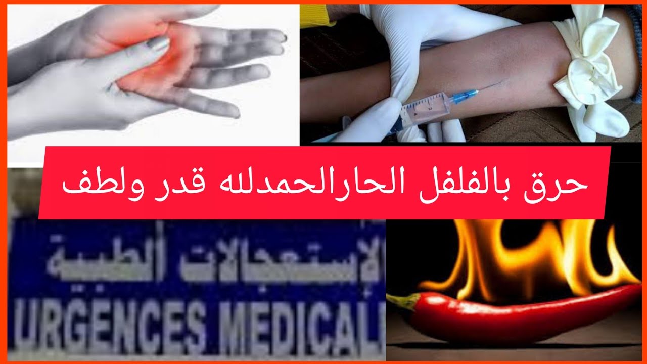 متغلطوش غلطتي😥 كيفاش تعالجي حرق والتهاب اليدين بالفلفل الحار بسرعة
