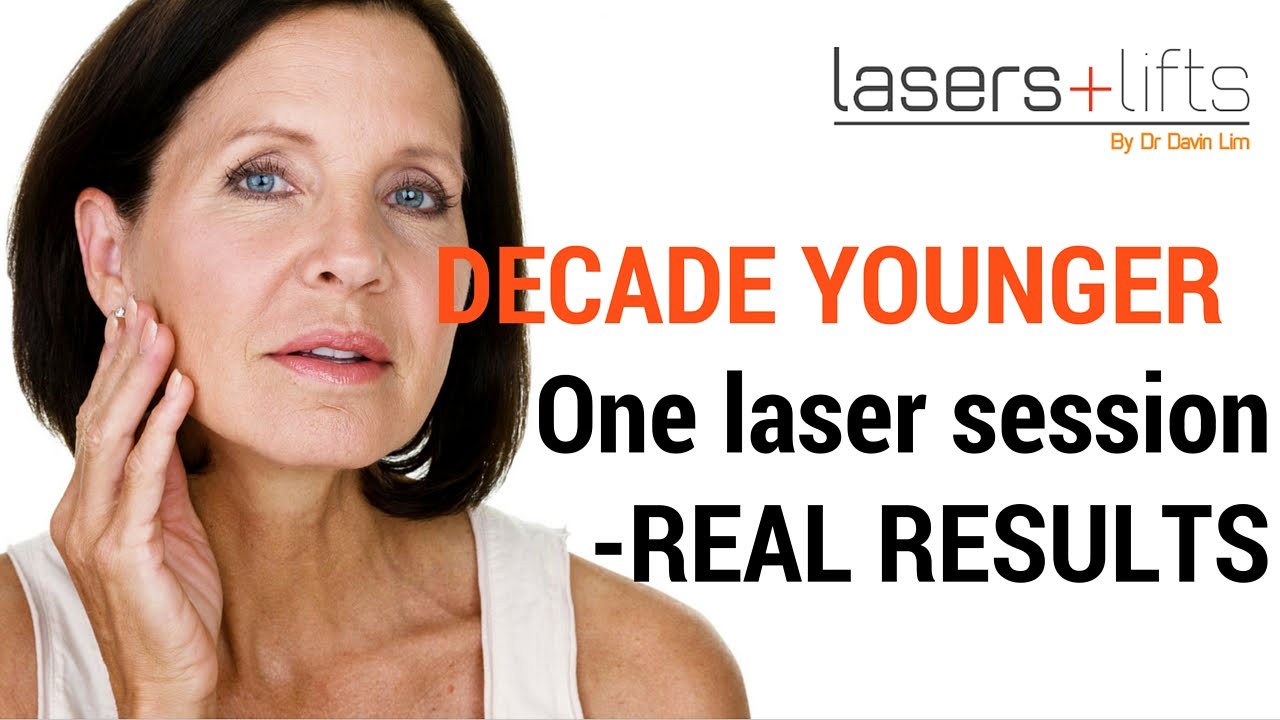 Laser resurfacing - one decade younger