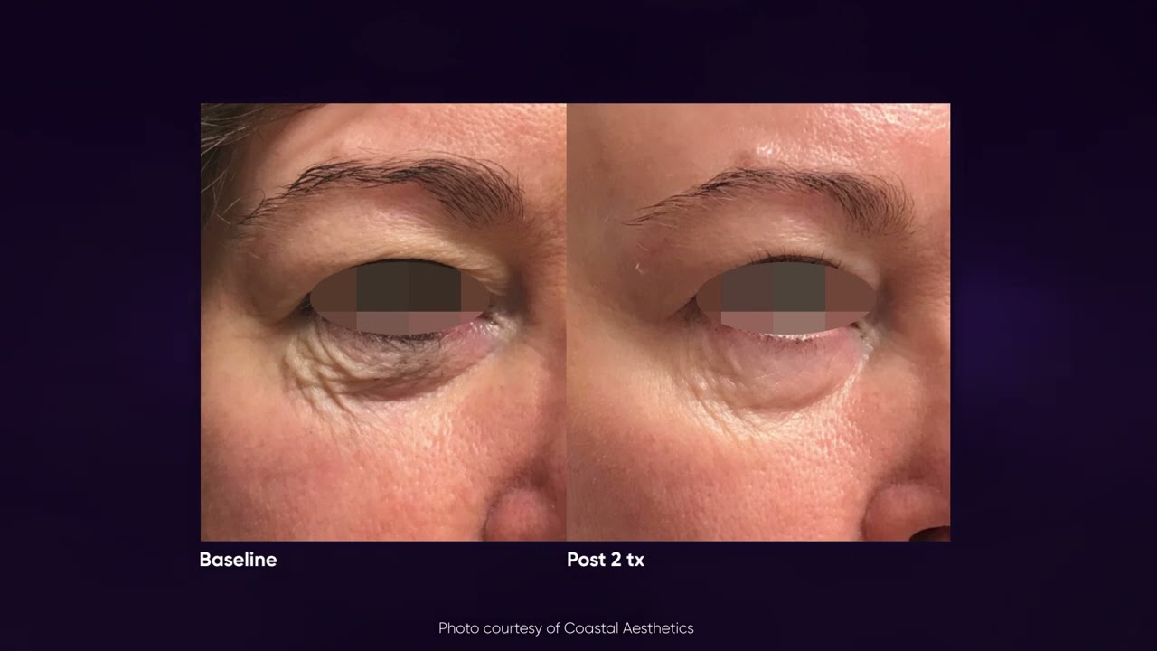 Opus Fractional Plasma RF Skin Resurfacing