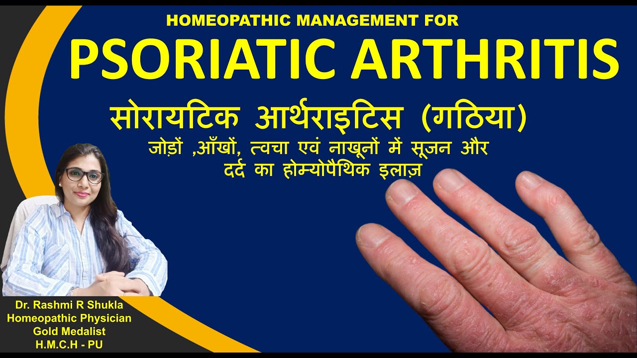 अब पायें सोरिएटिक आर्थराइटिस से हमेशा के लिए छुटकारा |Psoriatic Arthritis Homeopathic treatment