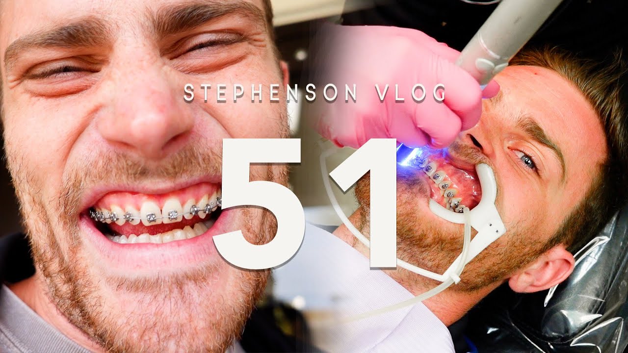GETTING BRACES AS AN ADULT - PART 2 #king