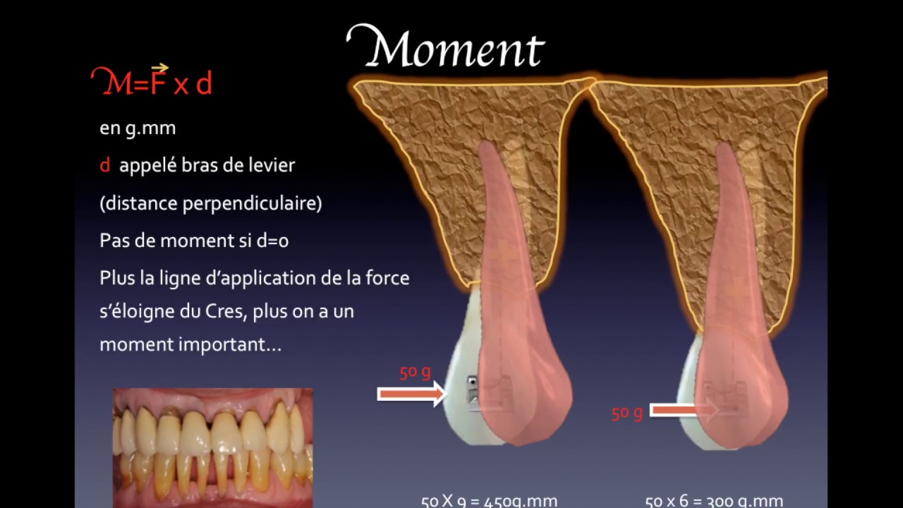 Biomécanique Orthodontique n°1