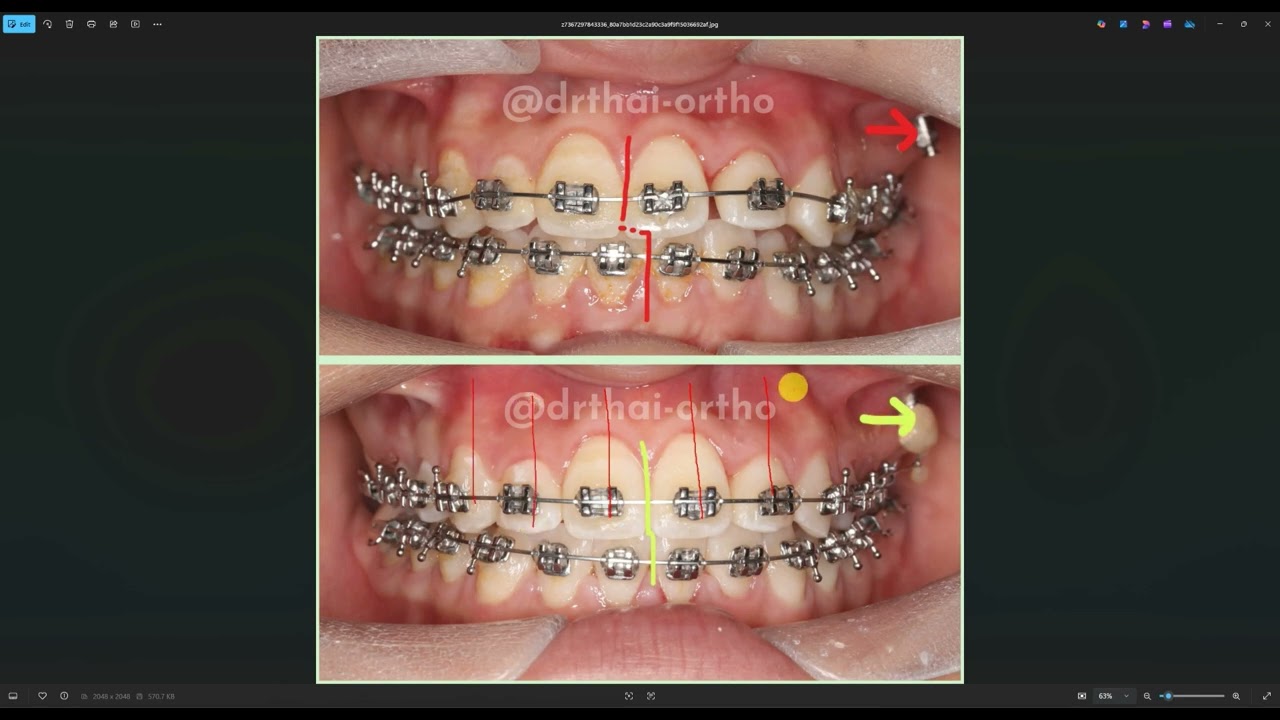 Lâm sàng: Lệch đường giữa trong Chỉnh Nha lại