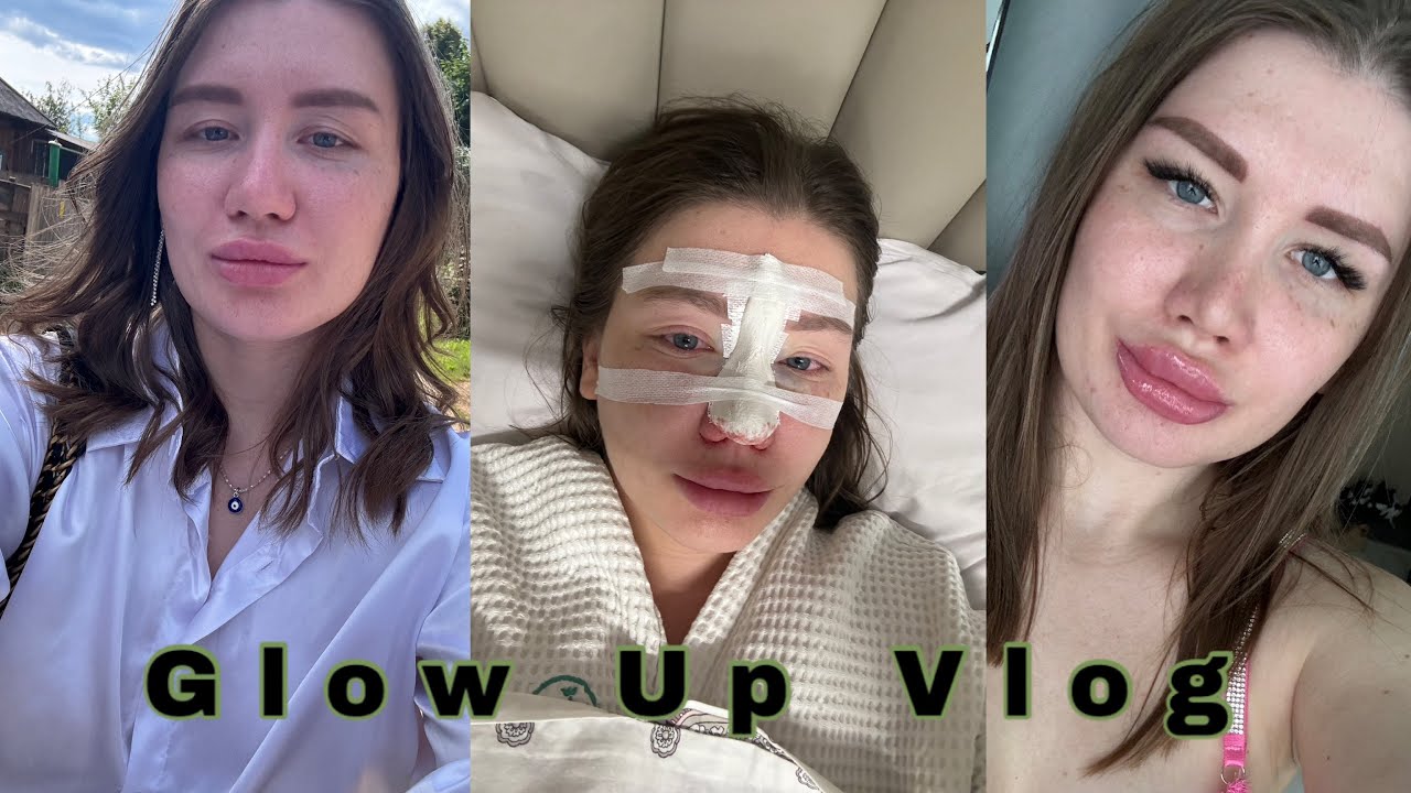 Glow up vlog: ринопластика, восстановление после ринопластики, губы, перманент бровей