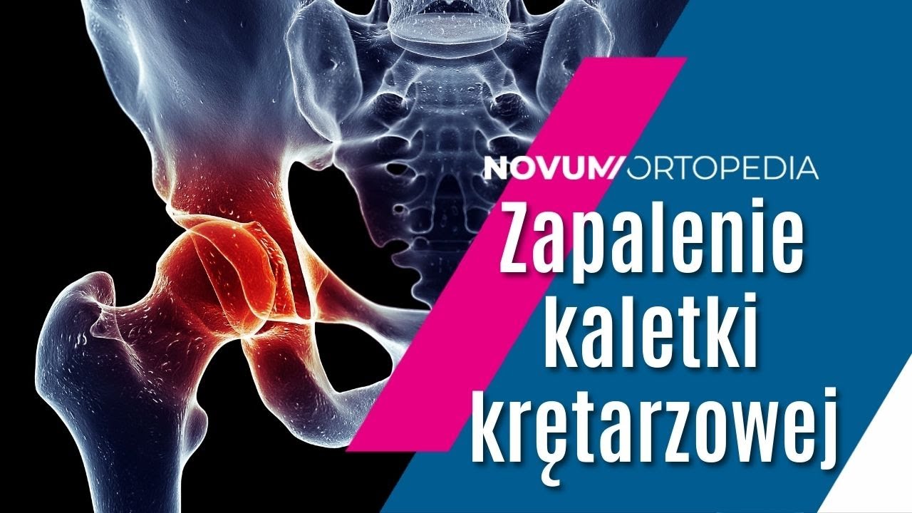Ból biodra? To może być ZAPALENIE KALETKI KRĘTARZOWEJ | Novum Ortopedia