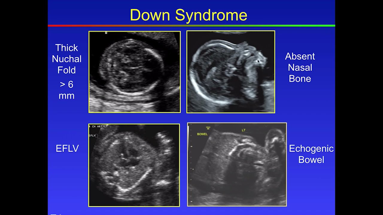 Fetal Congenital anomalies  part2