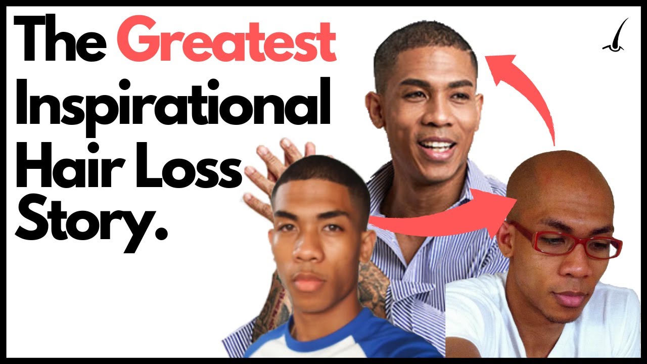 This is How I Overcame Hair Loss.