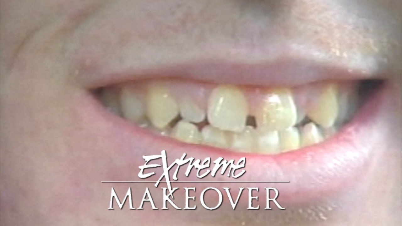 Dr. Bill Dorfman Transforms Michaels Smile on ABCs Extreme Makeover
