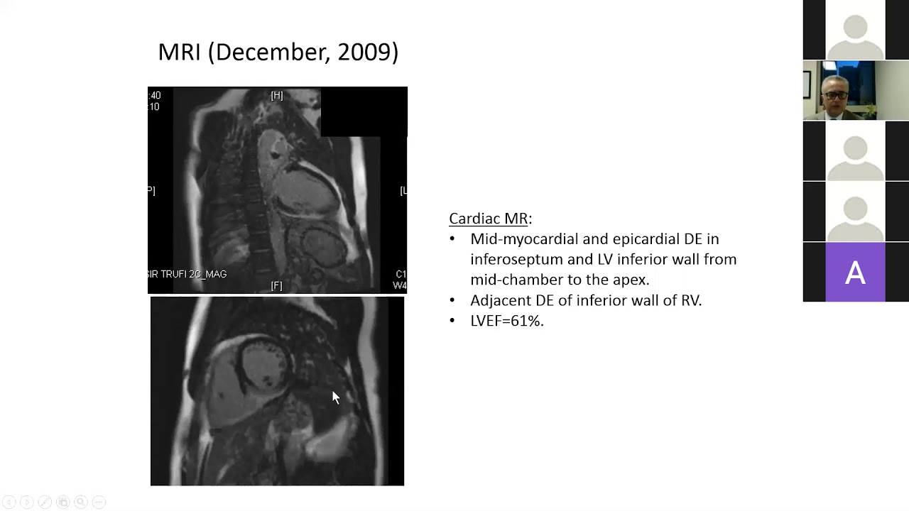 10 23 20 Chicos Cardiac Sacroidosis