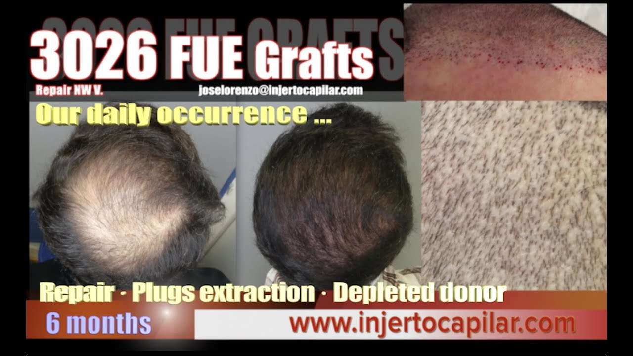 3026FUE Grafts. Repair/plugs extraction/donor depletion. 6months growth.Injertocapilar.com.2793/2022