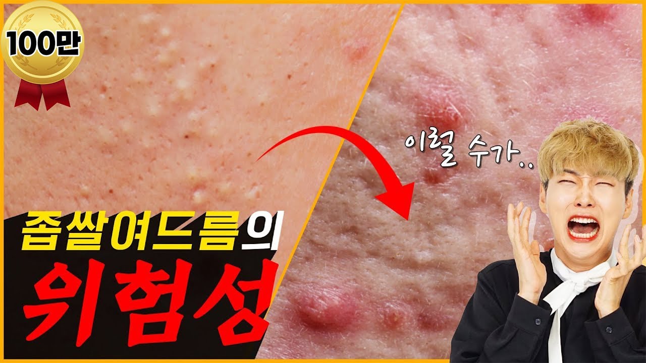 Eng) 좁쌀여드름 예방&박살내는 방법!│좁쌀여드름의 위험성│고민해결 (feat.염증성 여드름) l 白ニキビの予防&無くす方法 ! l 白ニキビの危険性！ (feat.炎症性ニキビ)