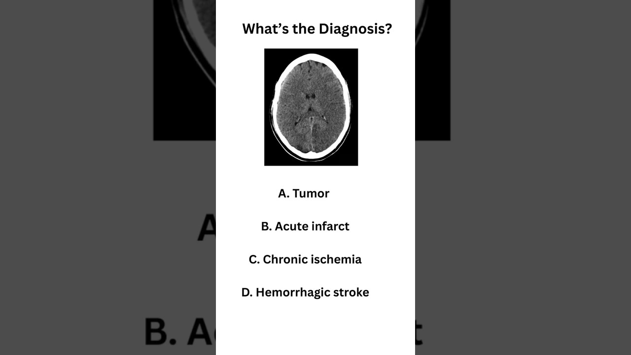 #mcq of the day #neetpg#inicet#upsccms#usmle#plab#fmg#Mbbs#medstudent##shorts