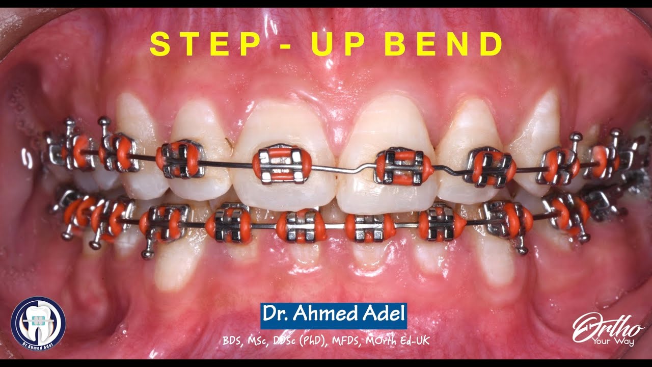 Step up bend in NiTi wire using step bend plier step by step by  dr ahmed adel orthodontics