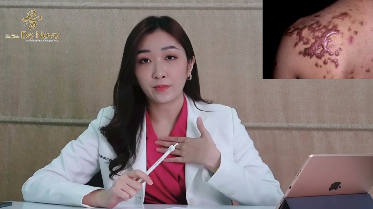 Keloid အမာရွတ် အကြောင်းသိကောင်းစရာများ