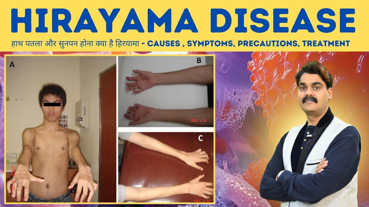 HIRAYAMA DISEASE  : हाथों की कमजोरी का असली कारण | Causes, Symptoms, Examination, Treatment