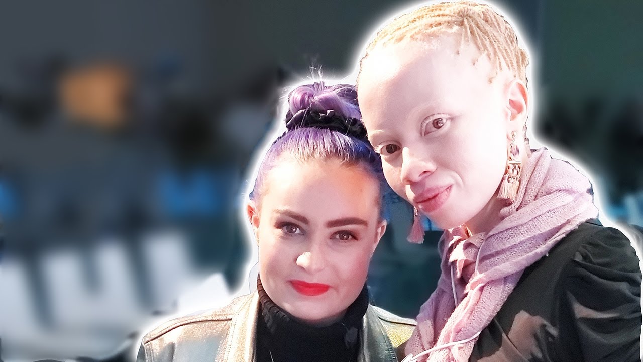A Black Woman with Albinism: Interviewing Thando Hopa