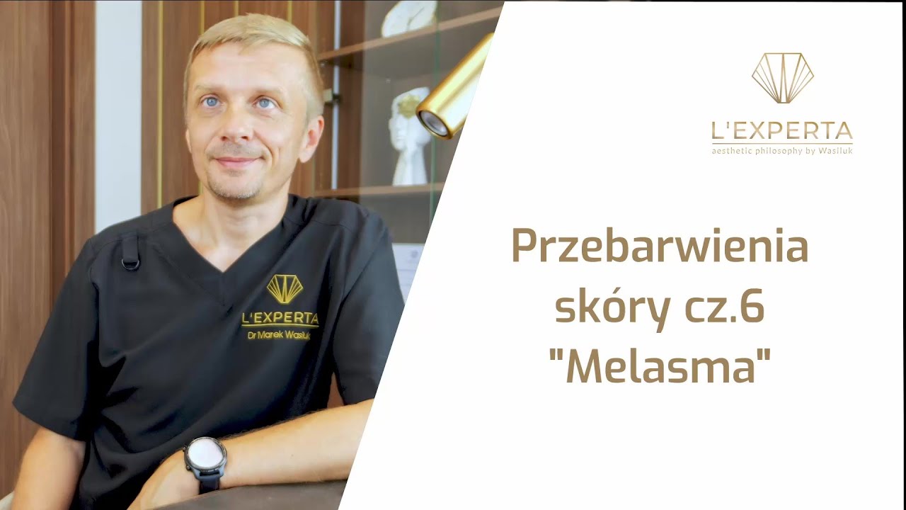 Przebarwienia - melasma - jak sobie z nimi radzić? | L'Experta