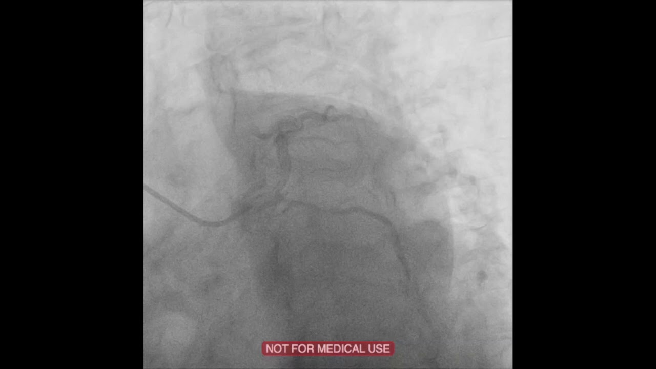 Mother and Child Technique Using STO Catheter during a Trans radial PCI of LCX in Post CABG Patient