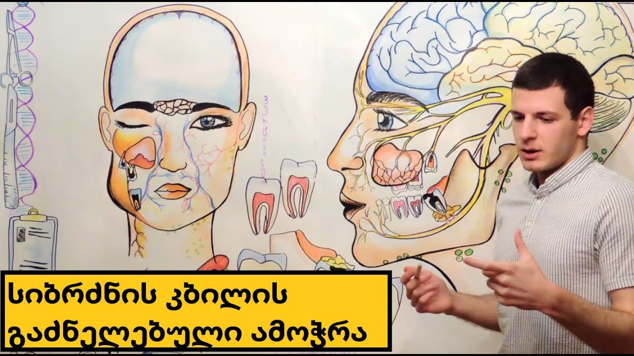 სიბრძნის კბილის გაძნელებული ამოჭრა