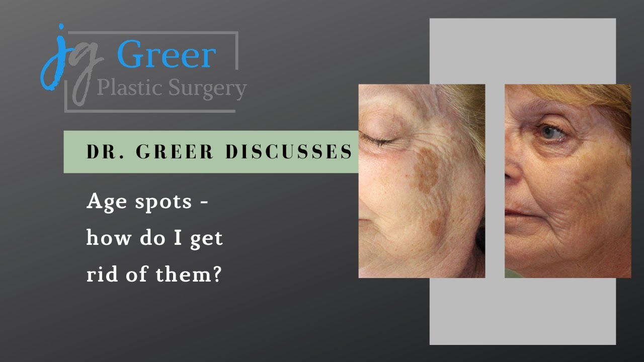 How Do You Get Rid of Age Spots? | Greer Plastic Surgery