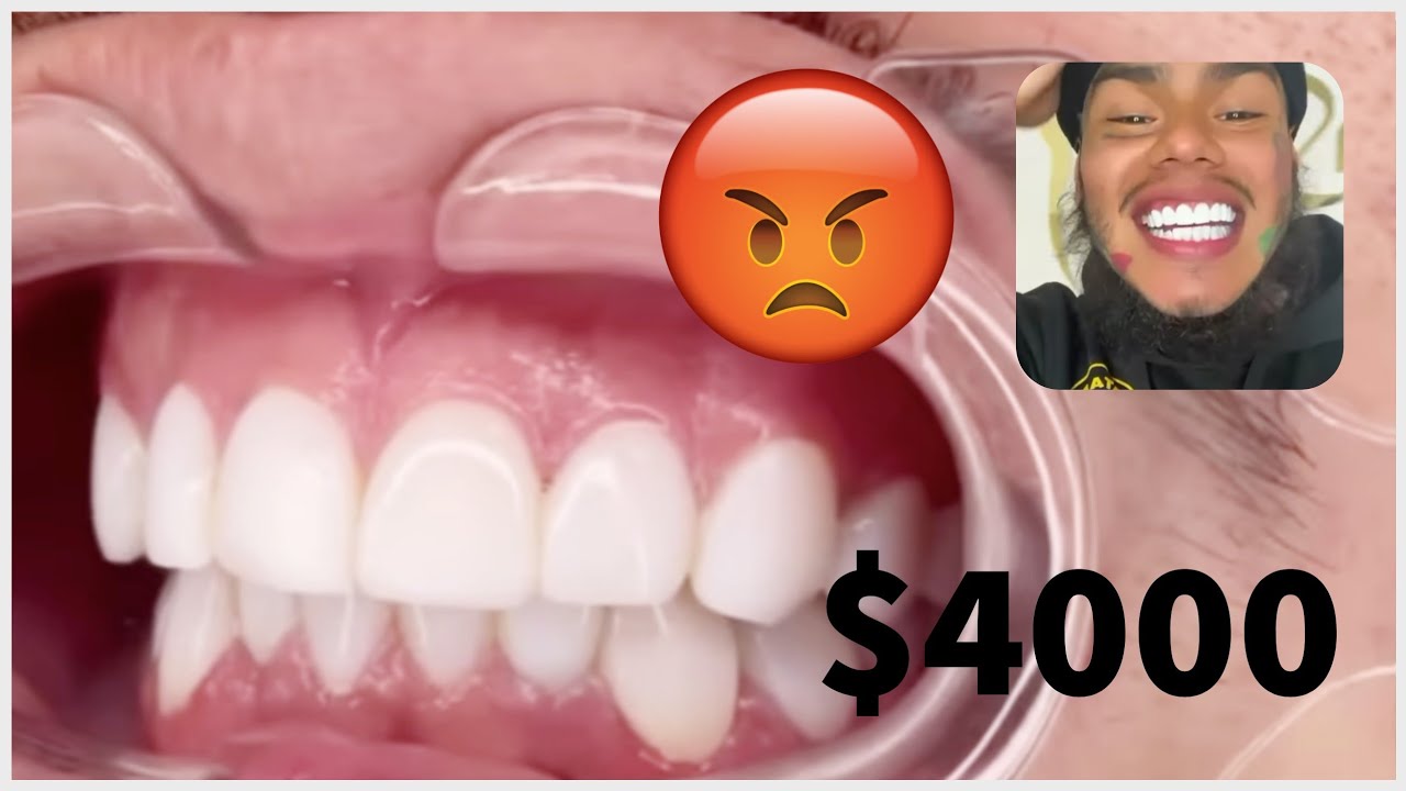 What Sucks of having done my teeth for $4k in Miami @dentaldesignSmile