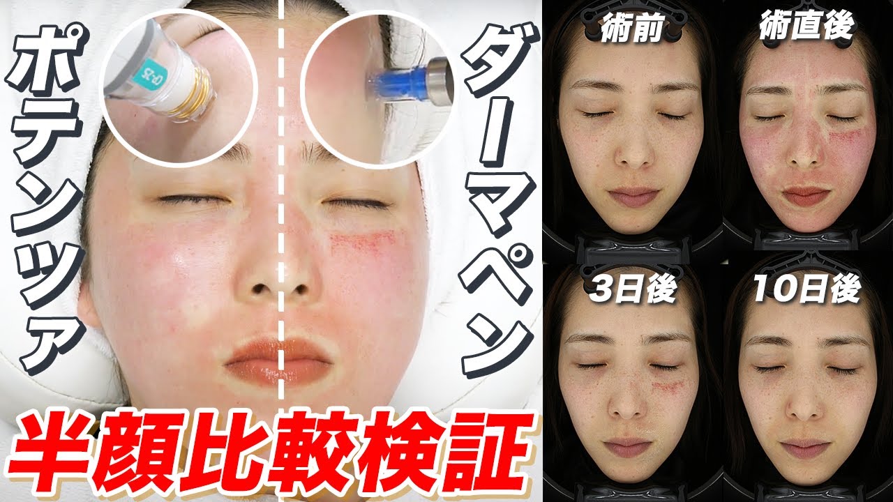 【半顔検証】ポテンツァvsダーマペン 痛みやダウンタイム経過の違いを徹底比較！
