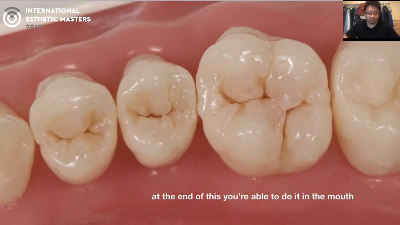 Esthetic Direct Composite Restorations