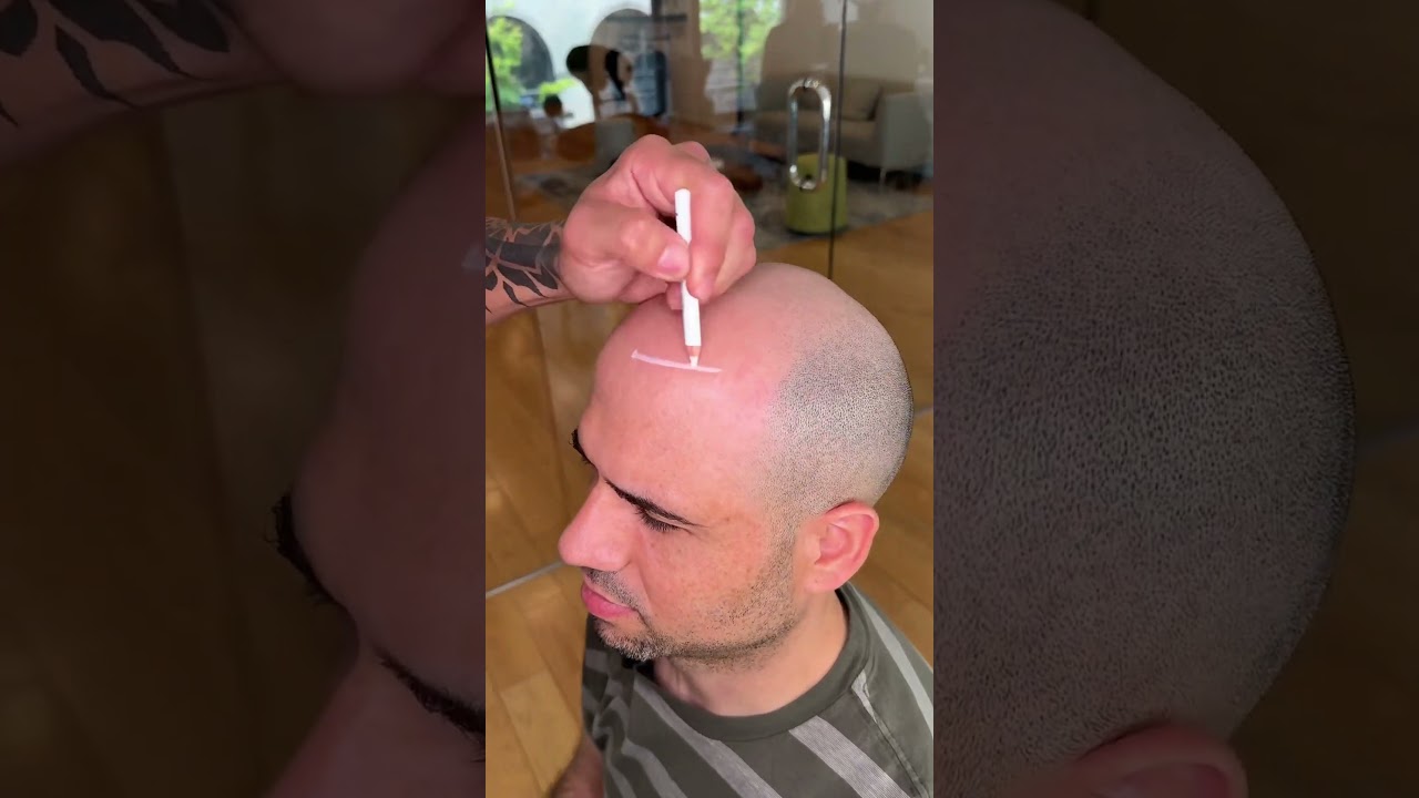Hair tattoo transformation 😱 #scalpmicropigmentation #hairlosscure #hairloss #hairtattoo #scalp