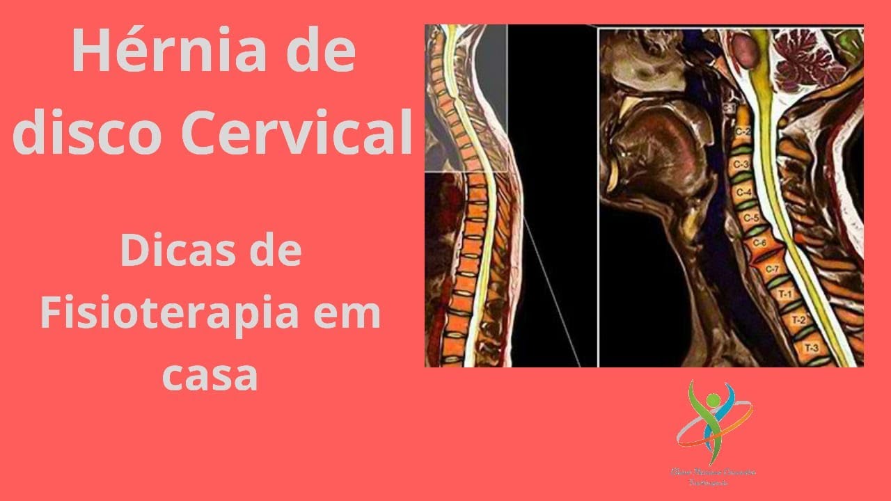 Hérnia de disco cervical. Dicas de fisioterapia em casa.