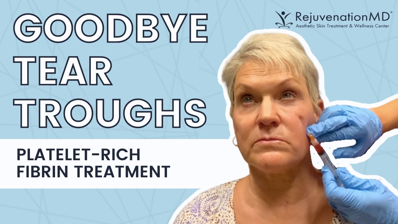 Platelet-Rich Fibrin Treatment for Tear Troughs