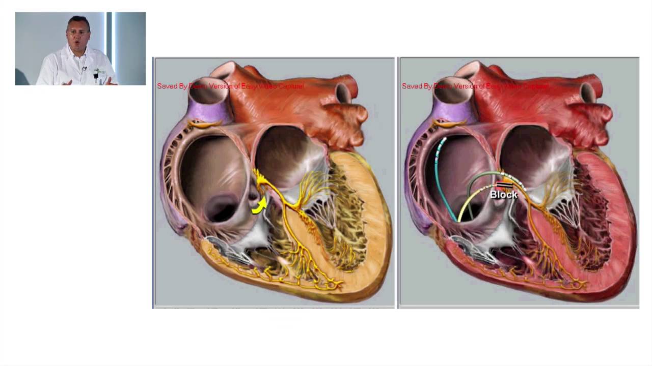 Taller Taquiarritmias Supraventriculares