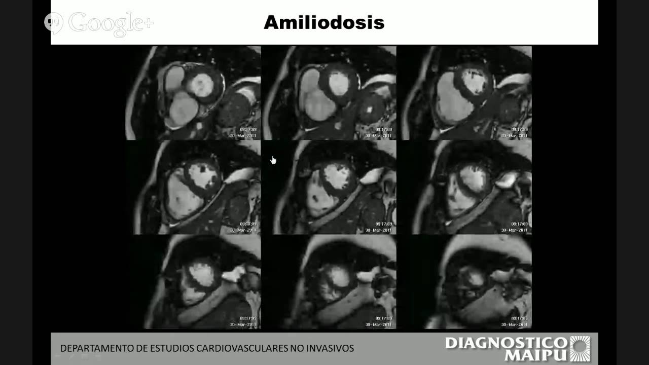 RMN CARDIACA; Dr Alejandro Deviggiano