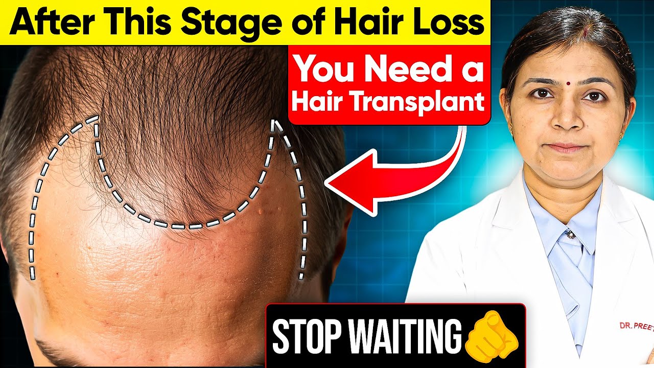 Если ваша линия роста волос выглядит ТАК — вам может понадобиться пересадка (пока не стало слишко...