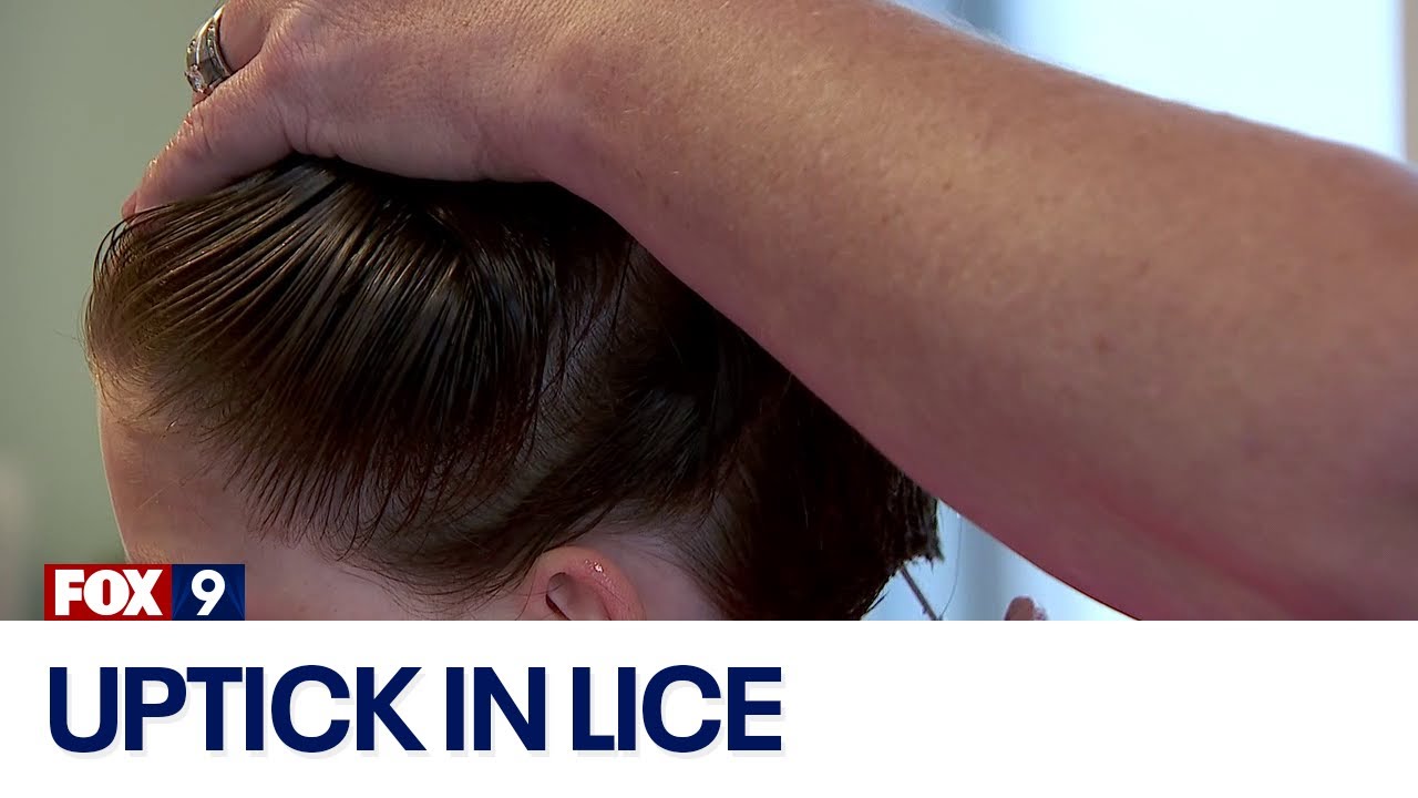 Lice uptick in Minnesota: Facts, prevention, treatment