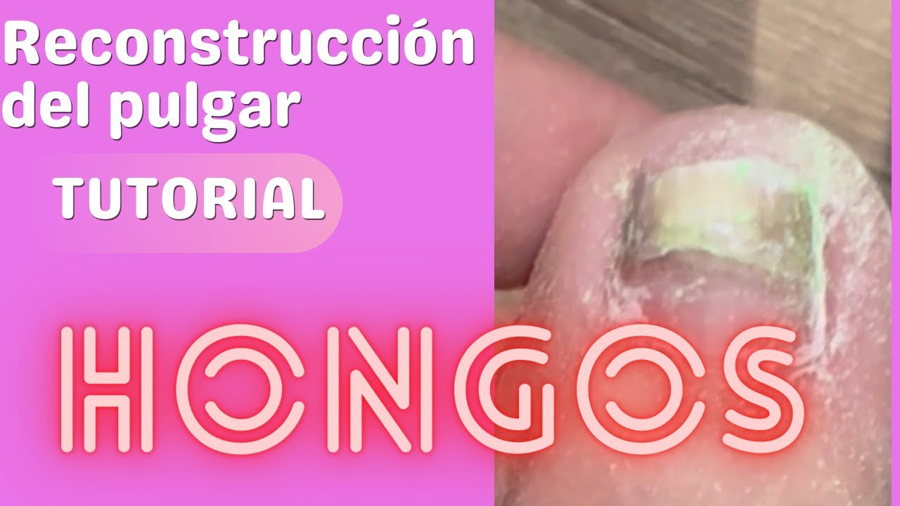 Hongos en las u&ntilde;as? Te ense&ntilde;o gratis a reconstruir el dedo pulgar del pie. Tutorial