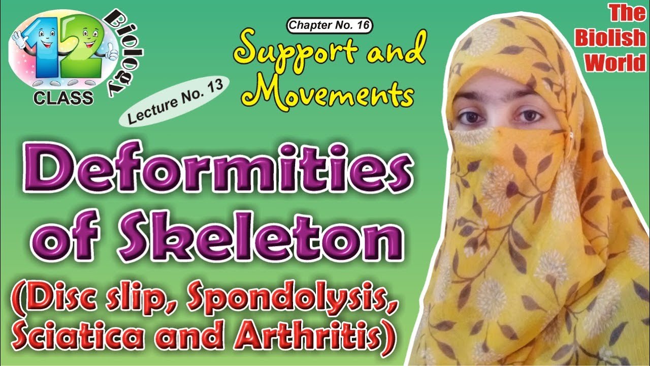 Deformities of skeleton ( disc slip, spondolysis, sciatica, arthritis).