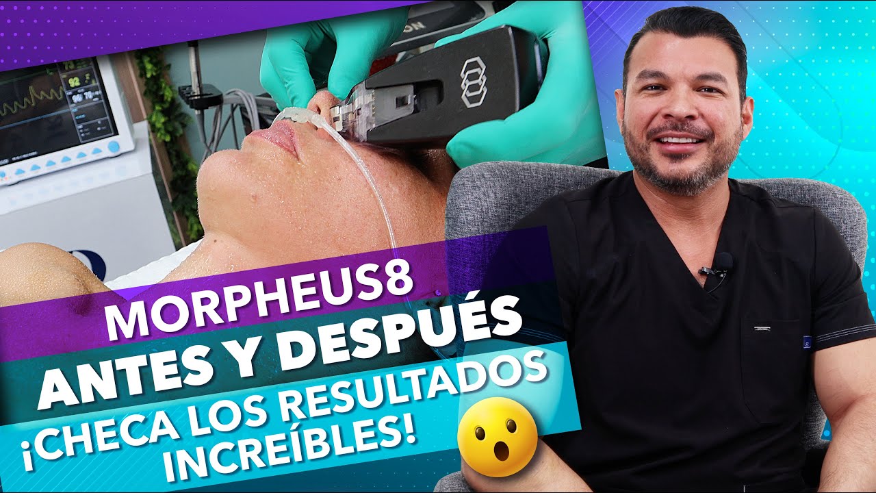 ¡Resultados increíbles con Morpheus8! | ANTES Y DESPUÉS | Dr. Romeo Castillo CIRUJANO PLÁSTICO | EP1