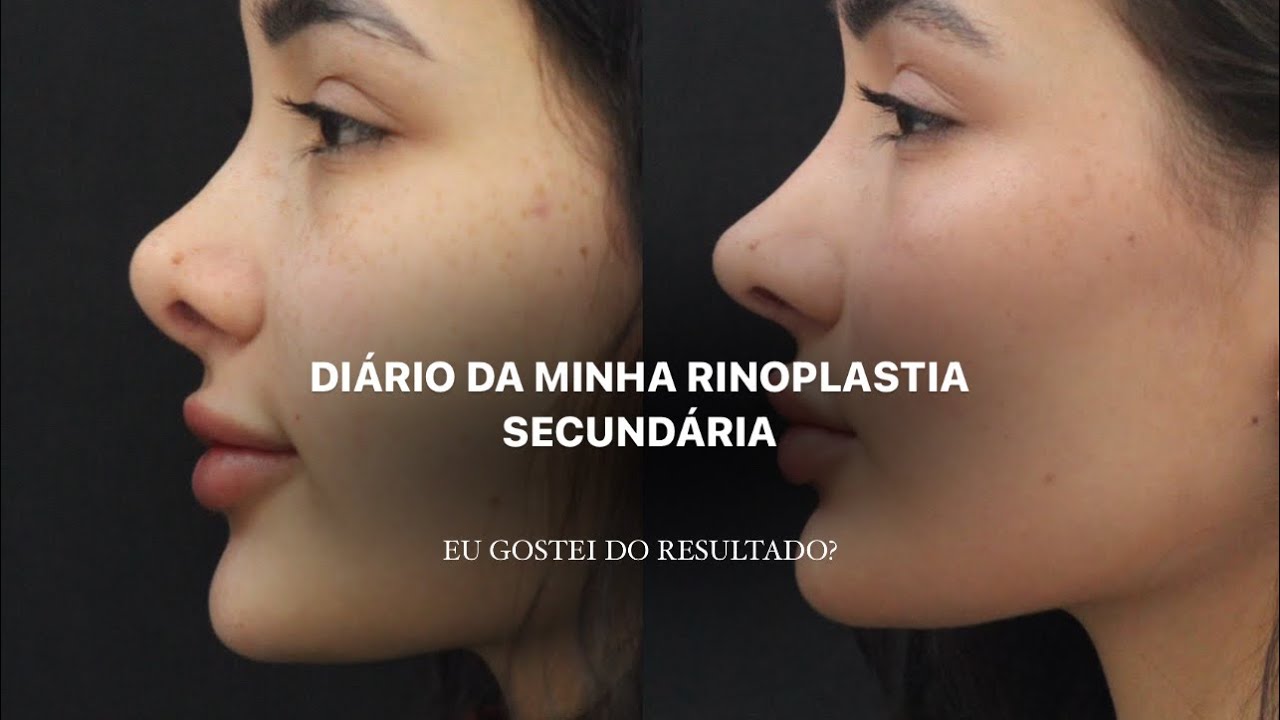 Minha rinoplastia secundária, enxerto de costela, meu pós operatório e o resultado depois de 4 meses