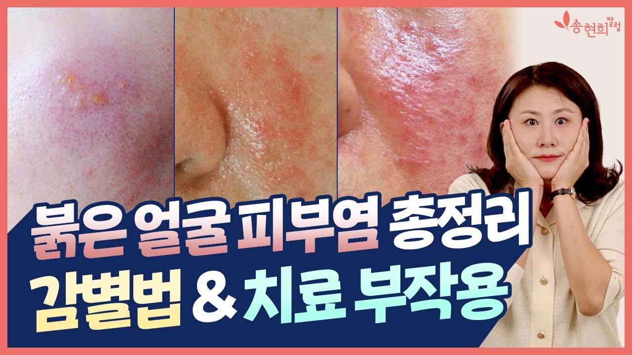 접촉피부염 vs 지루성피부염 vs 주사피부염 주의사항👉 엘리델, 수란트라, 로섹스겔