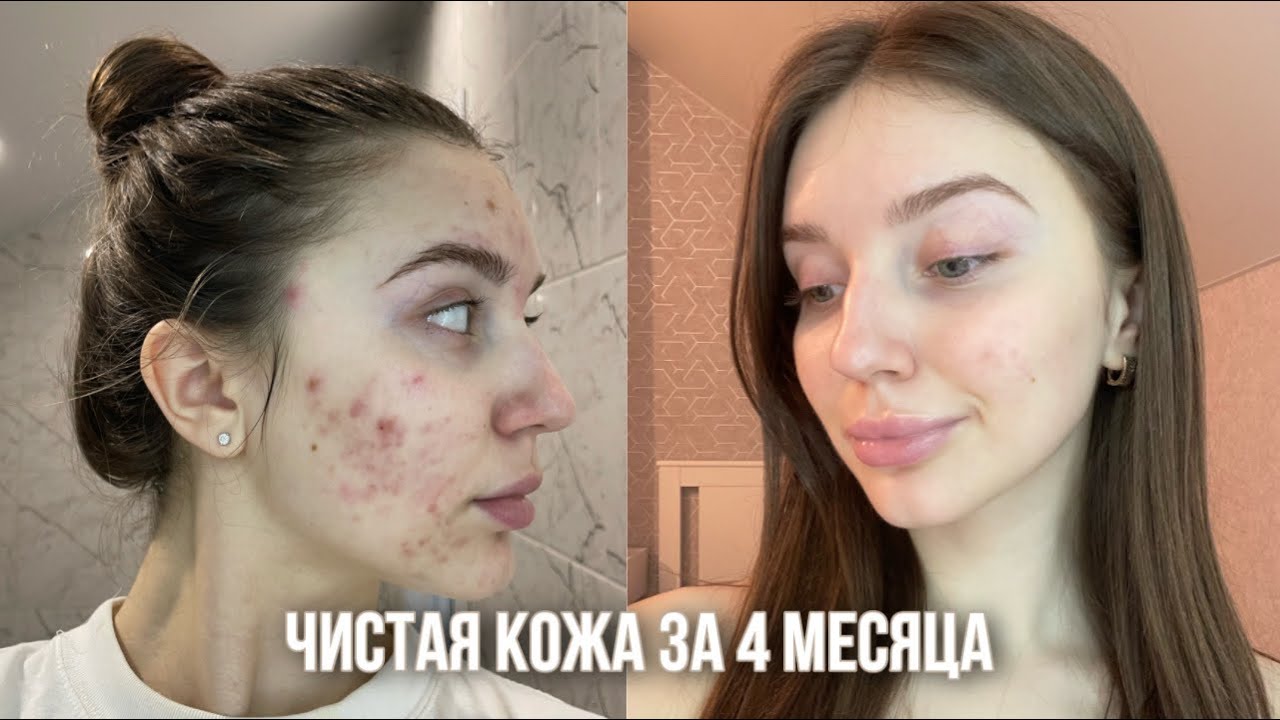 Как я вылечила АКНЕ 🤍| Моя история лечения кожи| АКНЕКУТАН | Уход за кожей